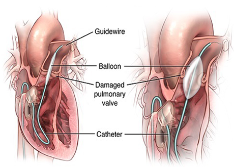 balloon mitral valvotomy treatment