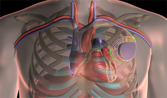 cardiac device implantation treatment in south delhi