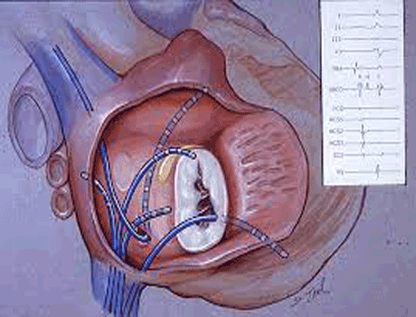 percutaneous valve implantation including tavi